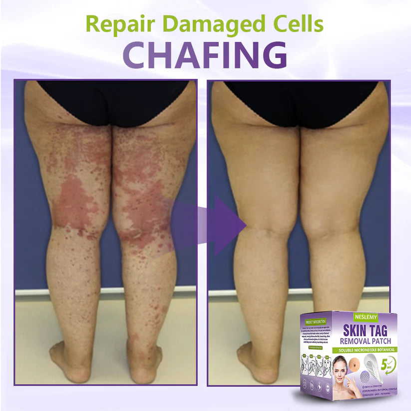 🌿NESLEMY® Rozpuszczalny plaster botaniczny z mikronakłuwaczami do usuwania narośli skórnych