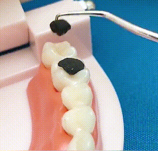 🦷Комплект клечки за зъби от неръждаема стомана